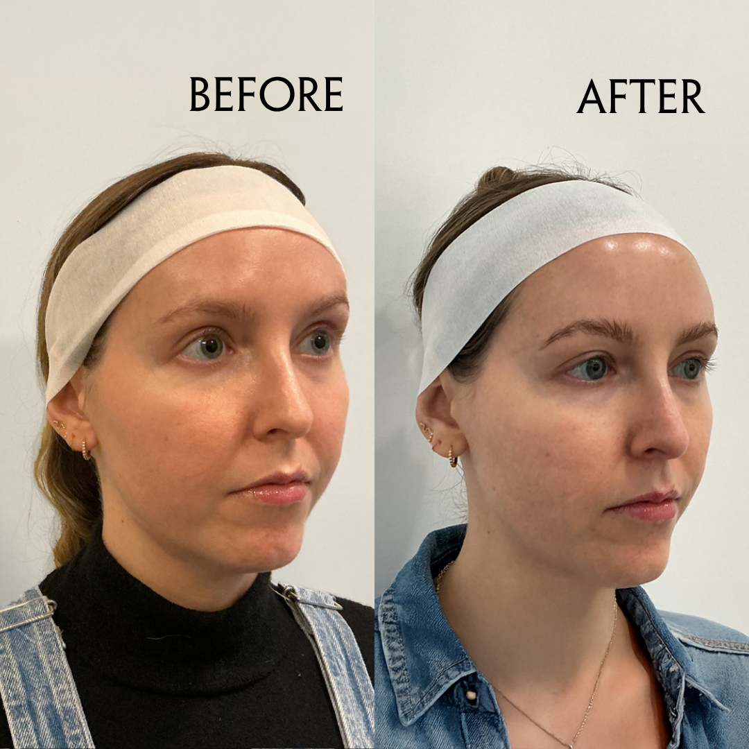 I Tried XERF, the New Korean Skin-Tightening Treatment All Over Your Feed