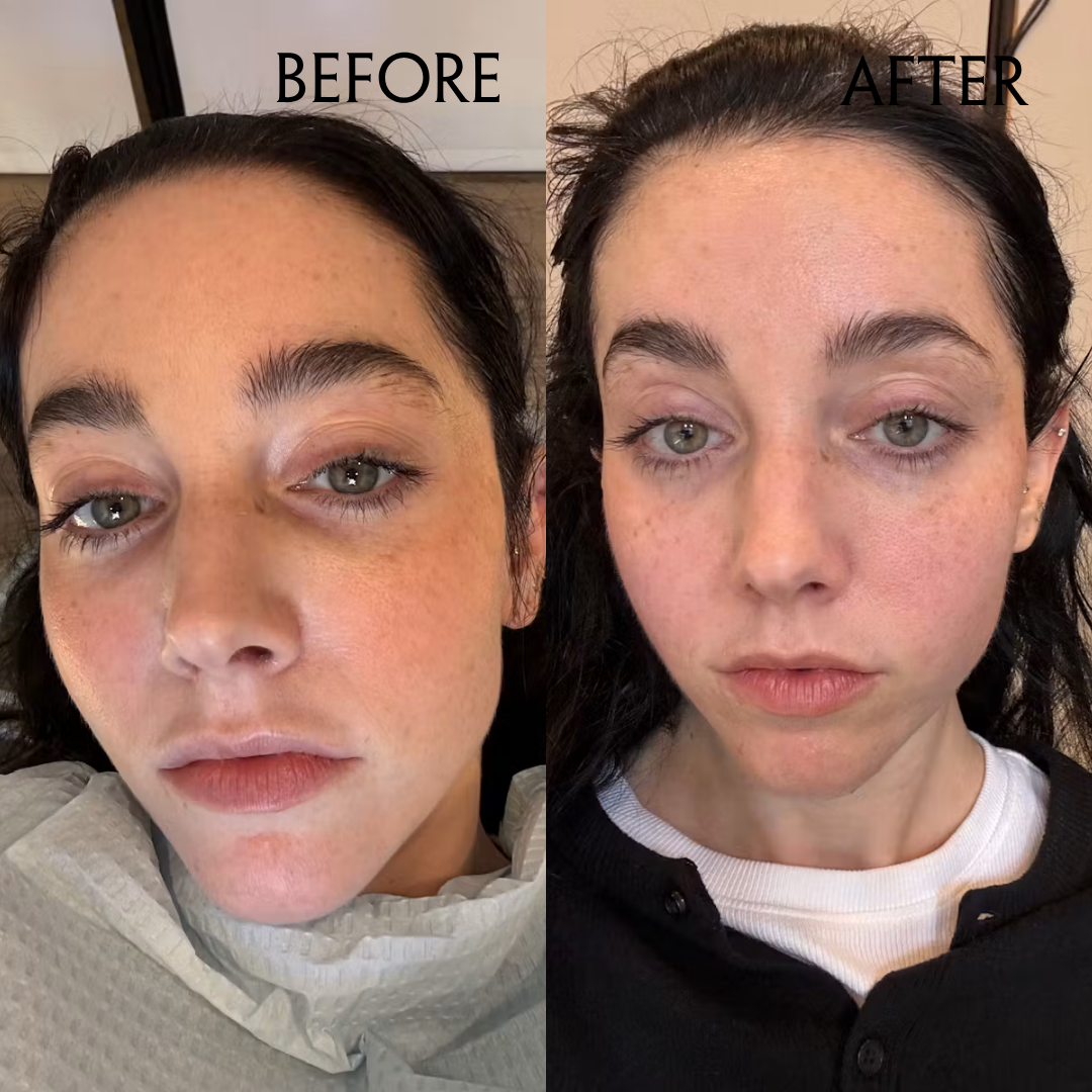 Is XERF The Closest Thing To An Instant Facelift?