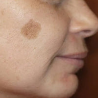 SohoDerm