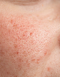 SohoDerm
